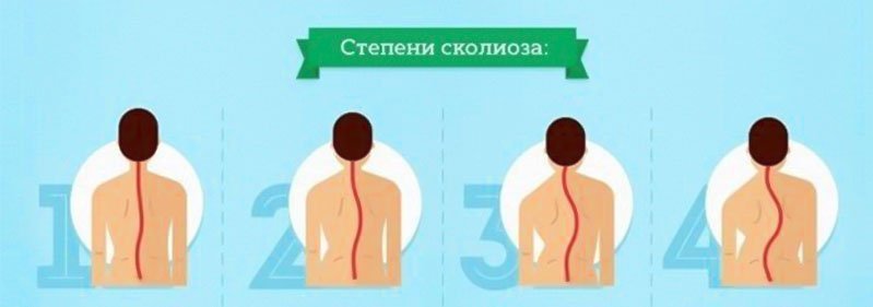 Степени сколиоза Степени сколиоза