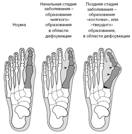 kostochka-na-bolshom-paltse.png
