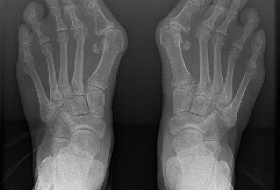 Hallux Valgus или почему растет косточка на большом пальце?
