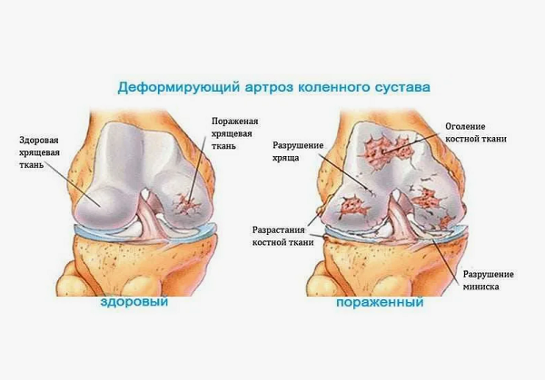 Деформирующий артроз Деформирующий артроз